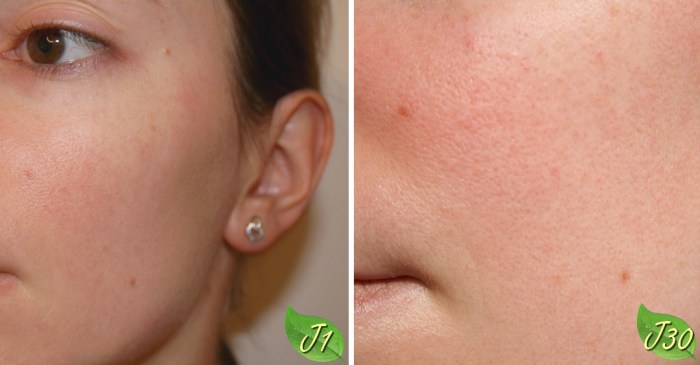 avant_après_centella