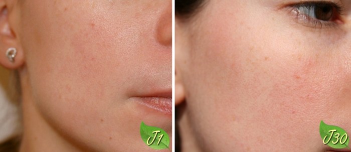 avant_après_centella_2